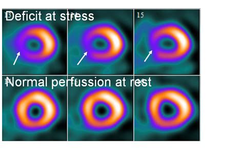 cardiac perfusion stress mibi.